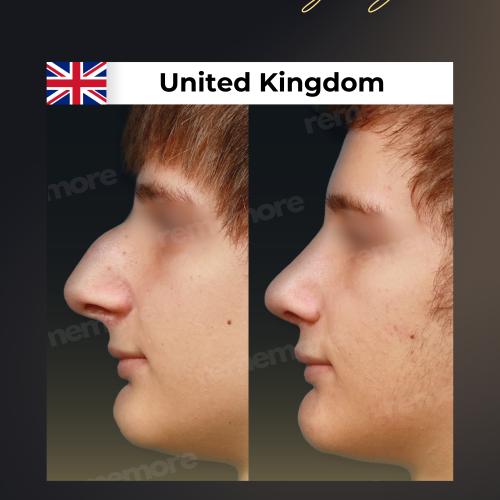 Perfiloplastia Foto antes/después